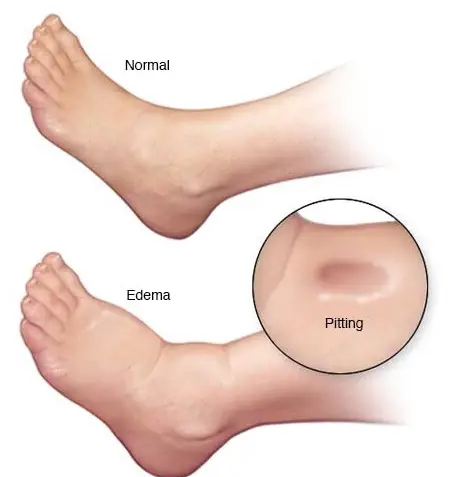 Compression Socks for Edema - How Long To Wear Them? 2 Condition of edema with pitting on calves