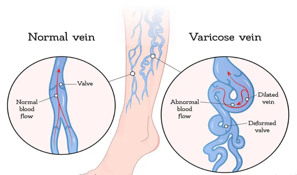 normal leg vs varicose veins leg