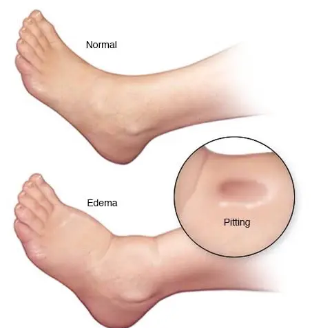 Condition of edema with pitting on calves
