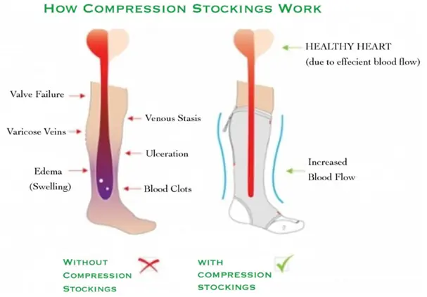Leg with no compression sock Vs leg with compression sock