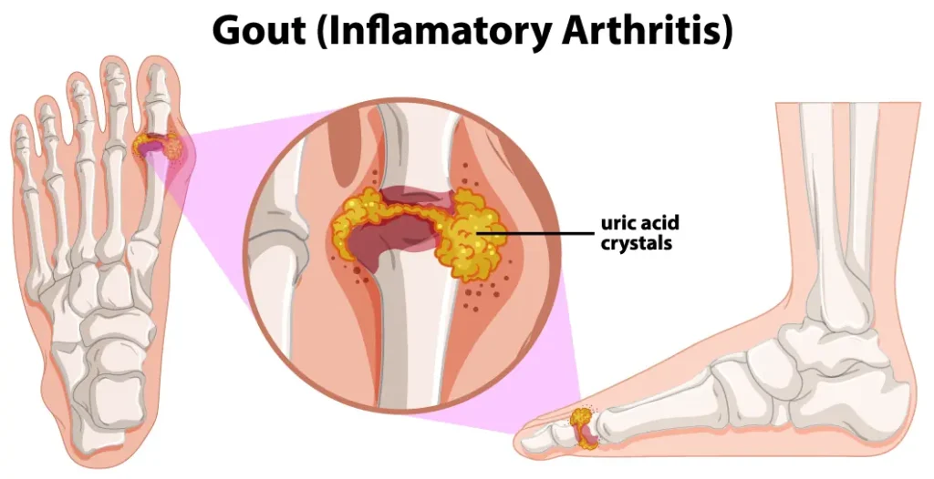 human anatomy of gout