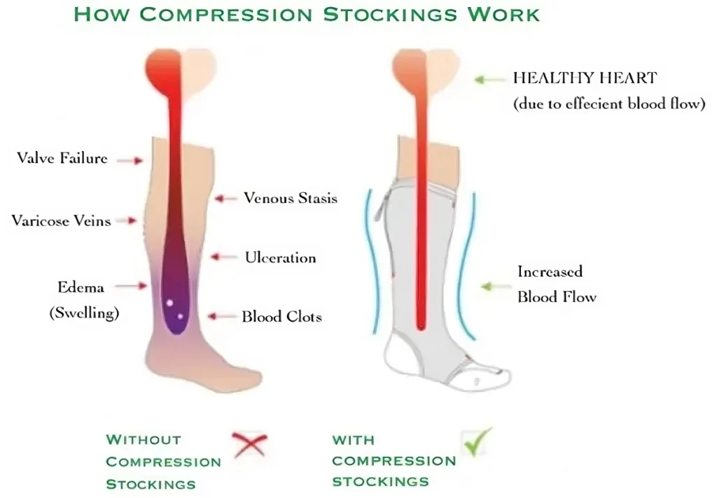 illustration of blood circulation with compression socks